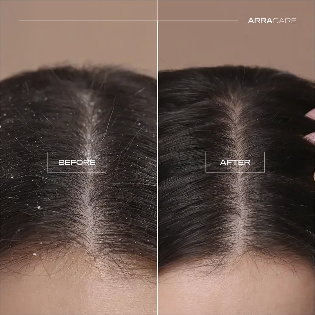 Dầu Gội Trị Gàu ARRACARE 80ml - Ảnh 3